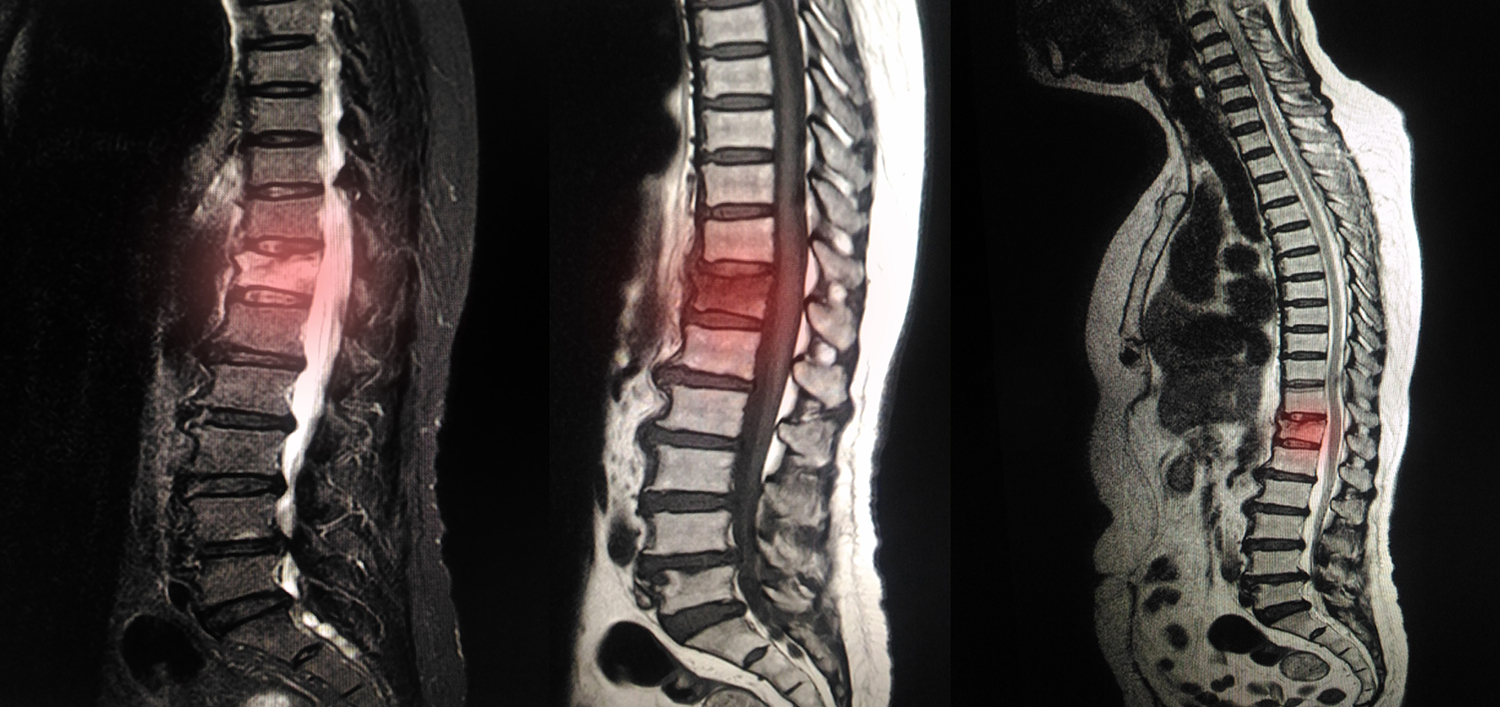 MRI scan of lumbar spines of a patient with chronic back pain showing degenerative change of lumbar and sacral spines with disc dessication and disc space narrowing.